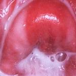 bacterial_vaginosis