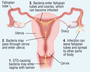 pelvic_inflammatory_disease