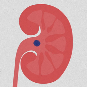 What Causes Kidney Stones? (Animated Video) – UrbanAreas.net